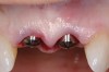 Figure 10  Temporary healing abutments are placed immediately following extraction of teeth 8 and 9. Note that there is no damage to the surrounding periodontium due to atraumatic extractions.