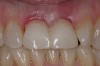 Figure 12  Buccal view of the implants immediately after provisionalization. Even at the temporary stage, the soft tissue closely mimicked the original periodontal drape.