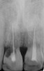 Figure 14  Initial periapical radiograph revealed internal root resorption of teeth Nos. 8 and 9 with almost complete horizontal severing of the crowns from the roots.