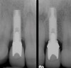 Figure 18  Periapical radiographs of the final implants show good bone levels and interproximal spacing between the implants and adjacent teeth.