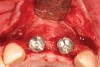 Figure 20  At the second-stage surgery following a healing period of 5 months, temporary healing abutments were placed. This occlusal view shows complete regeneration of the labial plate of bone.