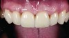 Fig 8. Final restorations showing good esthetic results and good soft-tissue integration.