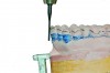 Fig 2. Blockout of cast for rigid (all-acrylic) appliance. Using a dental model surveyor, a straight vertical (occlusal surfaces of teeth parallel to countertop) or slight anterior-to-posterior path of insertion is established. The height of contour of the facial and palatal surfaces of the teeth is marked (see line on teeth). Using the undercut gauges, areas of undercut ≥ 0.01 inches on anterior and premolar teeth and ≥0.02 inches undercut on molar teeth are identified (see blue shading on teeth). These areas (and voids and other undercuts on the cast) are blocked out with wax or blockout compound. The blocked-out model is duplicated to serve as the working model for fabrication of the appliance. Blockout information courtesy of Laura Sheppard, CDT (Device Masters Dental Laboratory, Traverse City, Michigan) and Dario Zuniga, CDT, MDT (University of North Carolina Department of Prosthodontics, Chapel Hill, NC).