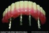 Fig 11. Fixed detachable implant retained bar appliance.