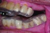 Fig 6. A MAD fabricated without casts being mounted according to the construction bite included with the case. Forward advancement of the mandible was not possible due to mechanical binding and blockage of the upper and lower tray components.