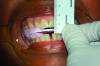 Fig 8. Illustration of required changes in the vertical dimension prescribed by the construction bite. Note that the anterior vertical dimension of the construction bite is 6.5 mm.