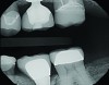 Fig 1. The mesial marginal ridge of the PFM tooth No. 19 is fractured, leaving an open proximal space between teeth Nos. 19 and 20.
