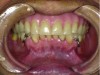 Fig 1. The patient presents with existing dentures with an uneven occlusal plane.