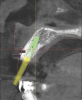 Fig 3 through Fig 5. The Simplant plan of the future implant position 3 mm apical and 2 mm
lingual to the CEJ of the proposed final restoration, including final guide design.