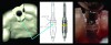 Fig 8 through Fig 10. The timing of the implant
is assured by lining up the index line on the guide (Fig 1) with the large dot on the driver (Fig 2). The clinical results are illustrated in Fig 3.