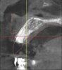 Fig 3 through Fig 5. The Simplant plan of the future implant position 3 mm apical and 2 mm
lingual to the CEJ of the proposed final restoration, including final guide design.