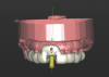 Fig 3 through Fig 5. The Simplant plan of the future implant position 3 mm apical and 2 mm
lingual to the CEJ of the proposed final restoration, including final guide design.