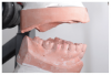 An upper denture ridge with
minimum topography.