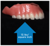 Atmospheric
pressure presses the
denture against the
ridge.