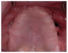 A severely resorbed upper ridge with oral-antral communication.