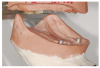 Class III relationship with a resorbed ridge and locators in the lower ridge.