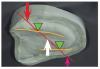 Limit contact to the lingual cusps (inside the yellow line).