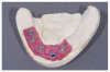 Lower implant distribution.