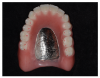Contact is limited to the lingual cusps of the upper posterior teeth.
