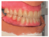 Lingualized occlusal
scheme.