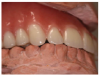 Contact is limited to the lingual cusps of the upper posterior teeth.