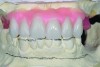 Diagnostic wax-up performed after model surgery simulating maxillary tooth extraction. Note that inferior repositioning of the incisal plane helped create the 15 mm to 17 mm of inter- occlusal space needed for the maxillary All-on-4 provisional restoration.