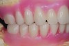 Completed diagnostic wax-up for maxillary and mandibular All-on-4 full-arch rehabilitation.