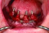 Surgical impression—Open-tray impression copings are secured and splinted with a denture-strengthening bar using low-expansion pattern resin.