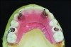 Indirect denture conversion—The indexed provisional prosthesis is modi ed for passive attachment of the posterior titanium cylinders to the prosthesis using heat-cured acrylic under pressure. This process is repeated for the anterior indexed implants, leading to a higher quality provisional with increased strength.