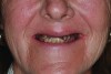 Pre-treatment smile of patient with terminal dentition.