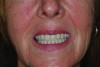 Patient smile shown 3 years post-treatment.