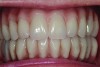Patient intraoral condition 3 years following delivery of maxillary and mandibular All-on-4 denitive prosthesis.