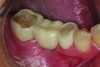 Fig 5. Short-span acetal resin implant provisional in place. (Photograph courtesy of Dr. David A. Little.)