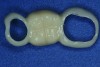 Fig 4. Short-span acetal resin implant provisional. (Photograph courtesy of Dr. David A. Little.)