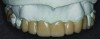 Fig 6. Esthetic overlay acetal resin removable partial overdenture.