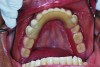 Fig 13. Occlusal view of mandibular RPD at time of insertion.
