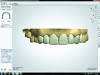 Fig 15. Maxillary anterior teeth digital design using CAD/CAM software.