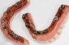 Fig 2. Typical problems that plastic hybrid dentures have.