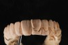Fig 13. A copy of converted denture that was modified by shaping.