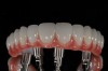 Fig 18. Full-monolithic zirconia prosthesis looks as good as natural teeth and layered ceramic.