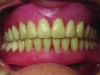Fig 4. Set-up try-in verifying fit, borders, bite, and tooth position.
