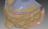Fig 10. Virtual articulation of the patient’s upper and lower jaws.