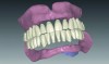 Fig 11. Virtual tooth placement and design of the denture.