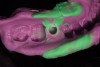 Fig 5. Implant-level impression with defect.