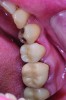 Fig 2. Final zirconia restoration.