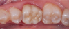 Fig 1. Monolithic molar crown of early translucent version of zirconia. Note that while the translucency is slightly better than the original tetragonal zirconia, it still does not provide excellent esthetics.