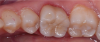 Fig 2. The zirconia crown shown in Figure 1 with 0.3 mm cut-back and a 0.3 mm layering of porcelain. Note the excellent esthetic match to the adjacent teeth with significantly improved translucency over the purely monolithic form.