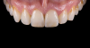 Fig 23. Images of complete monolithic cubic zirconia crowns (tooth No. 9).