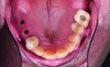 Fig 1. Occlusal view of maxillary arch with healing caps removed from implant fixtures in upper right quadrant.