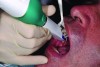 Fig 3. Intraoral scan on upper arch using the Planmeca Emerald scanner.
